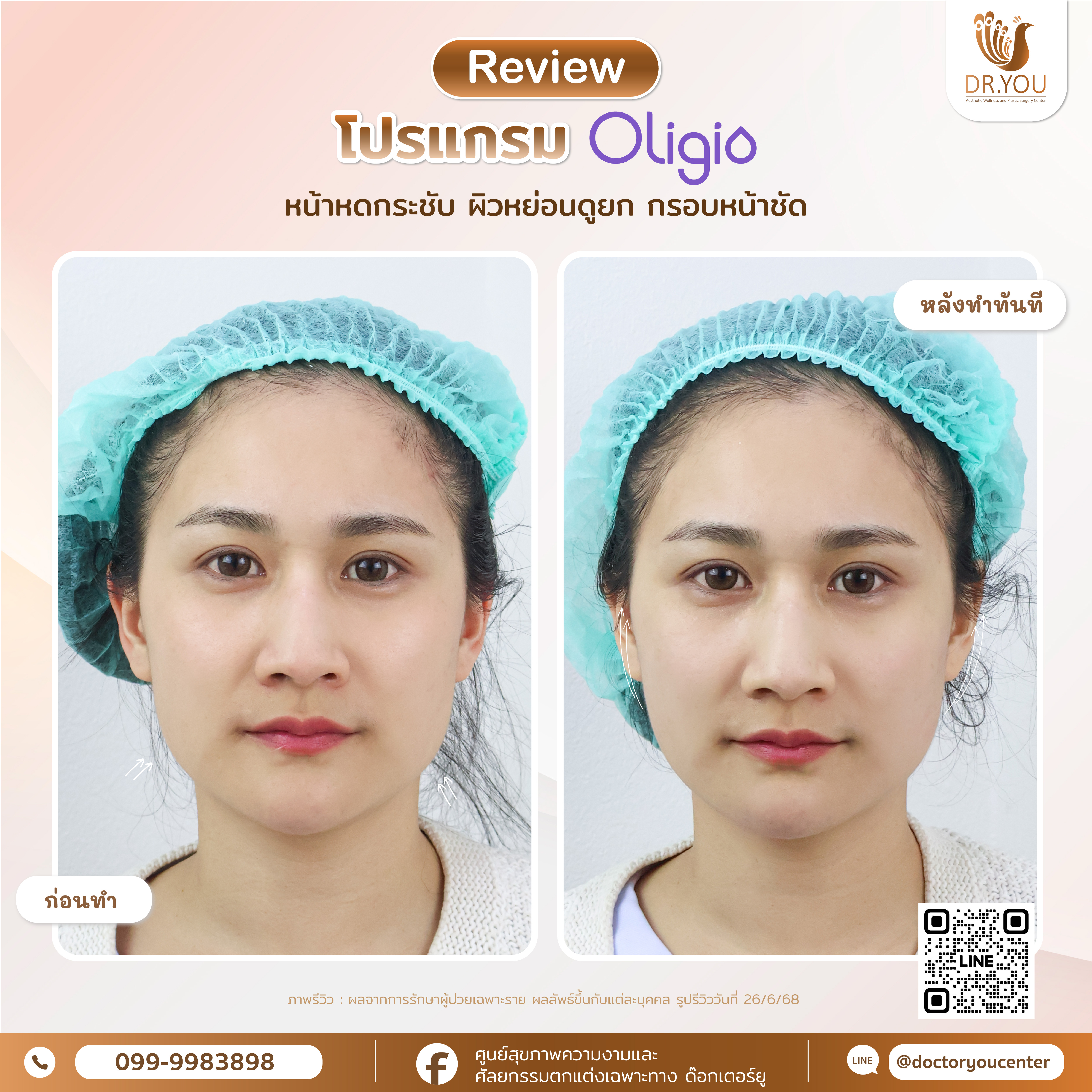 รีวิว Oligio