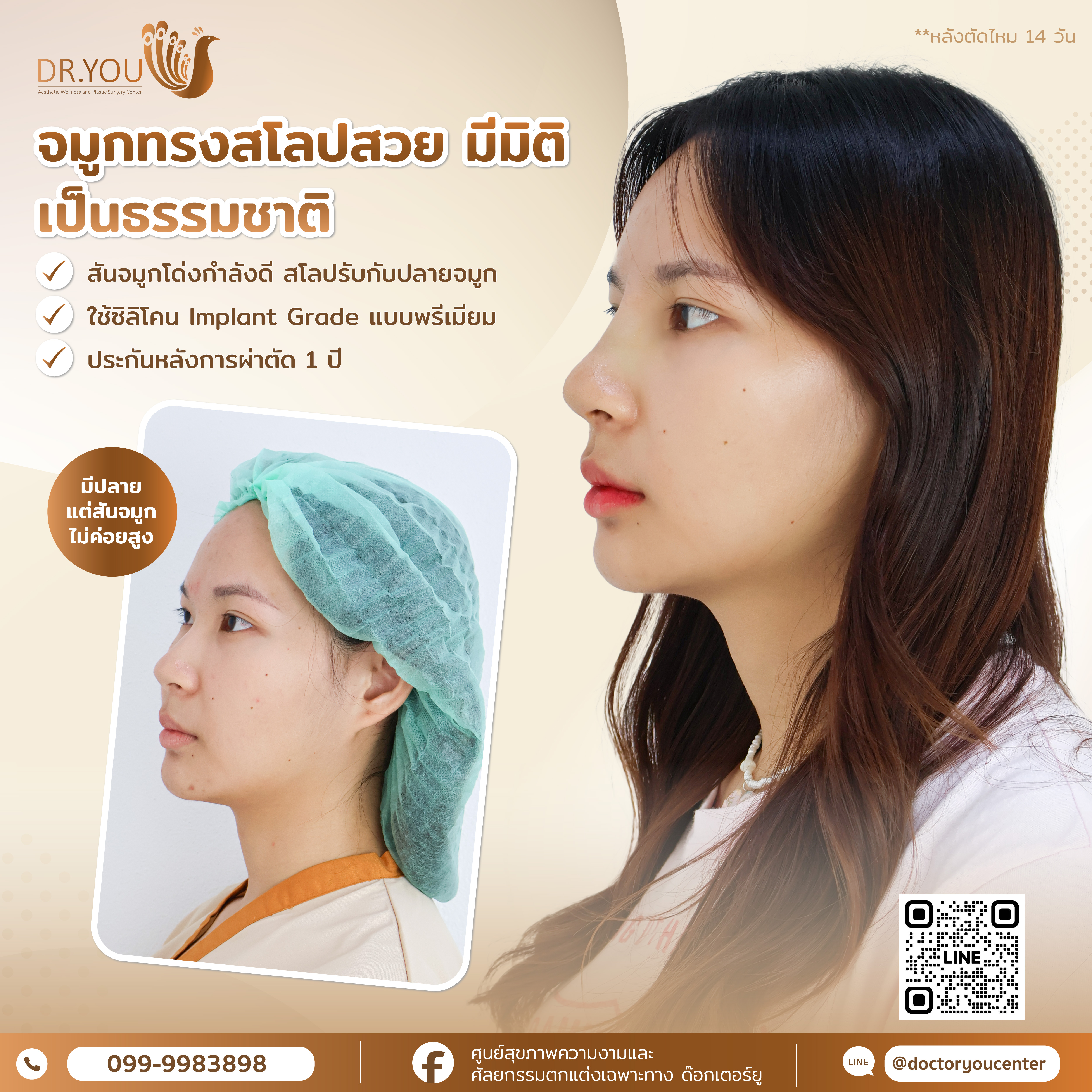 รีวิวก่อน-หลังเสริมจมูก