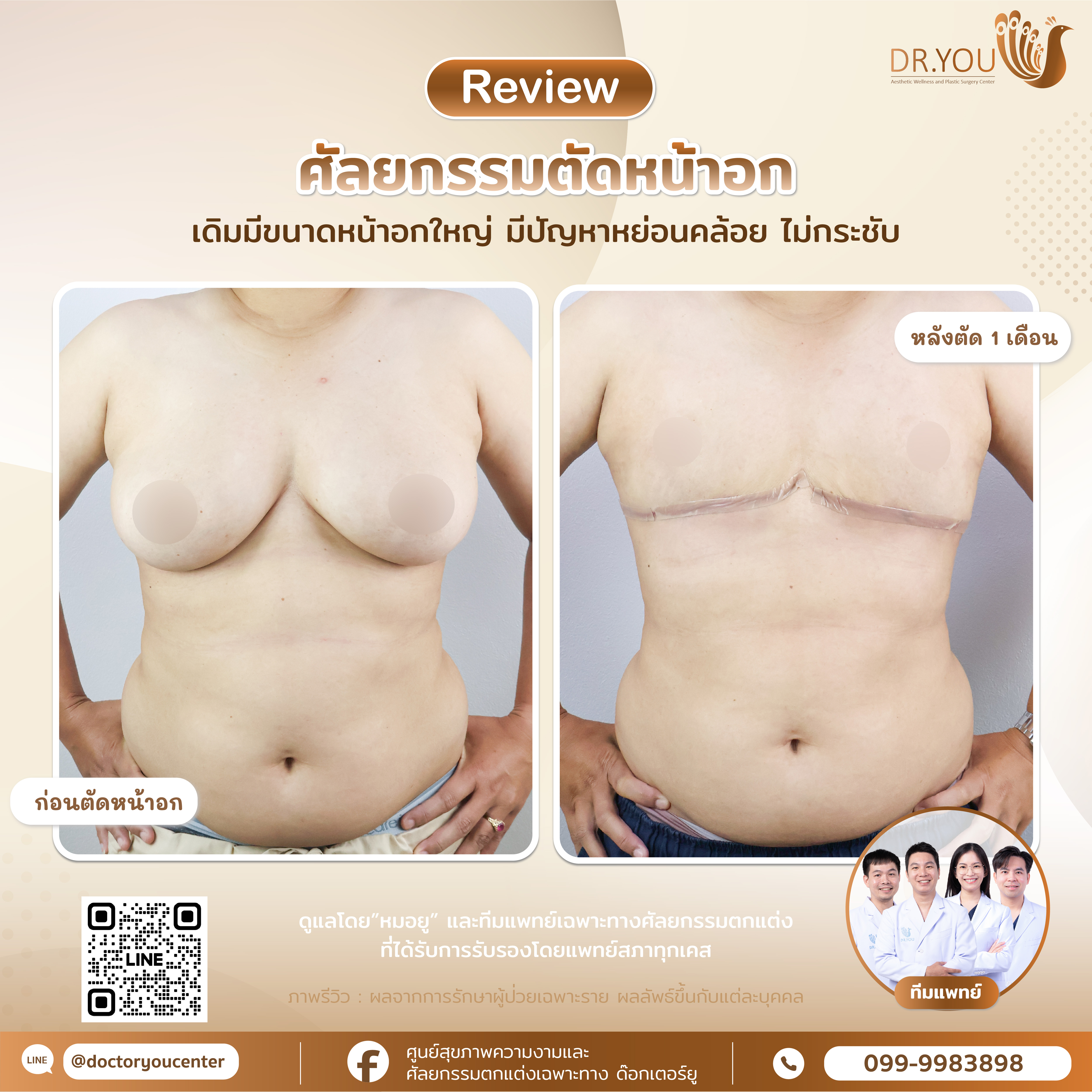 รีวิวศัลยกรรมตัดหน้าอก