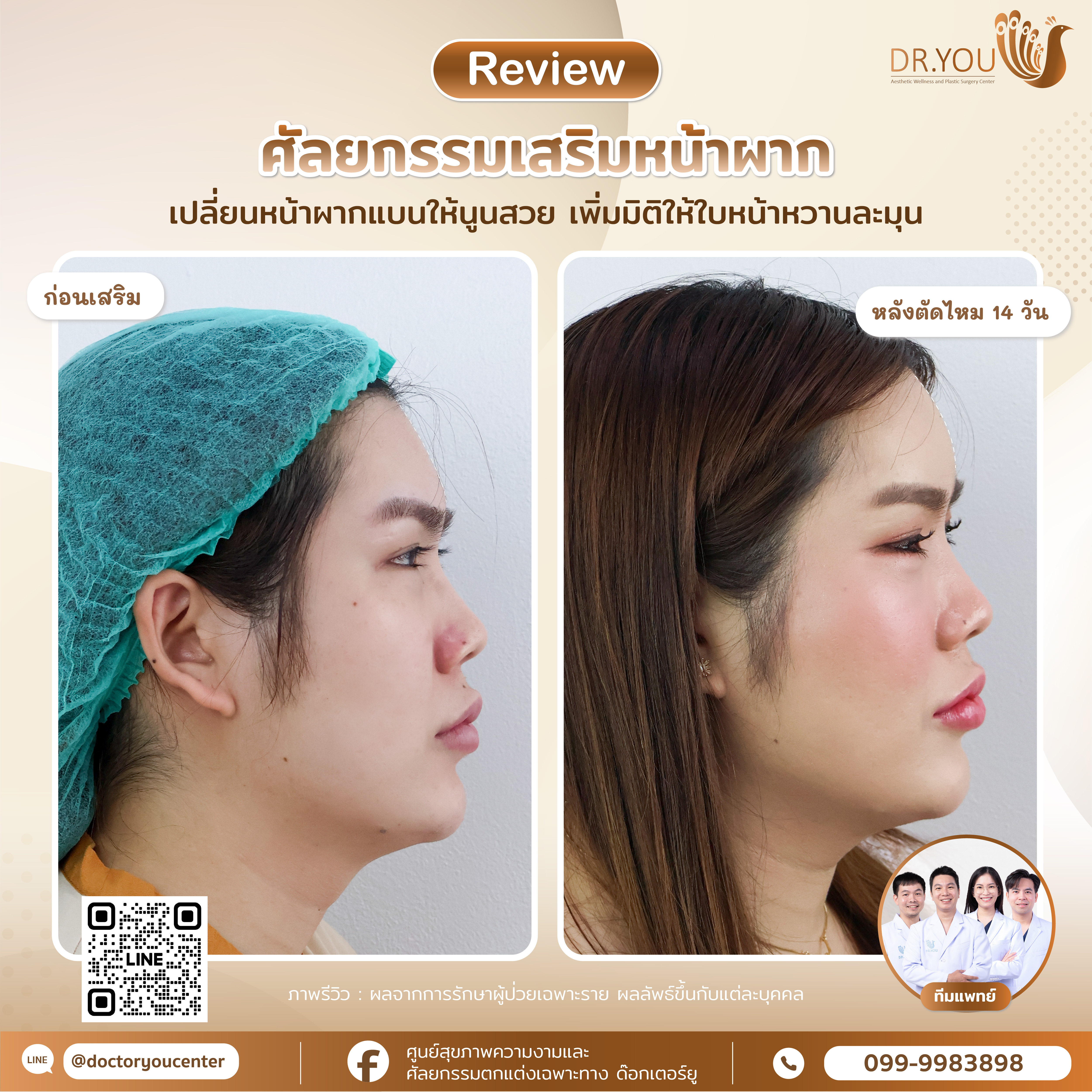 รีวิวเสริมหน้าผาก