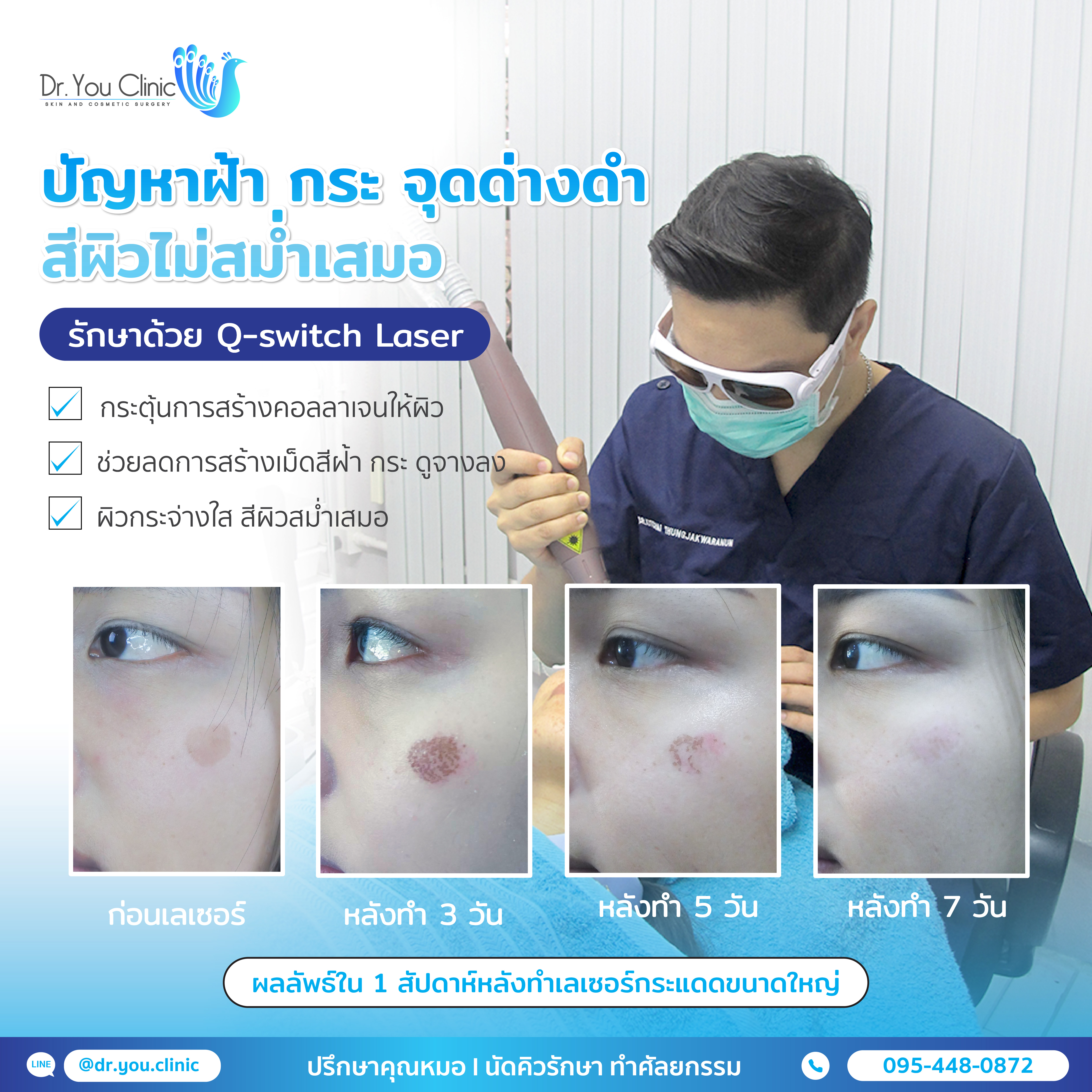 รีวิวเลเซอร์ฝ้า กระ