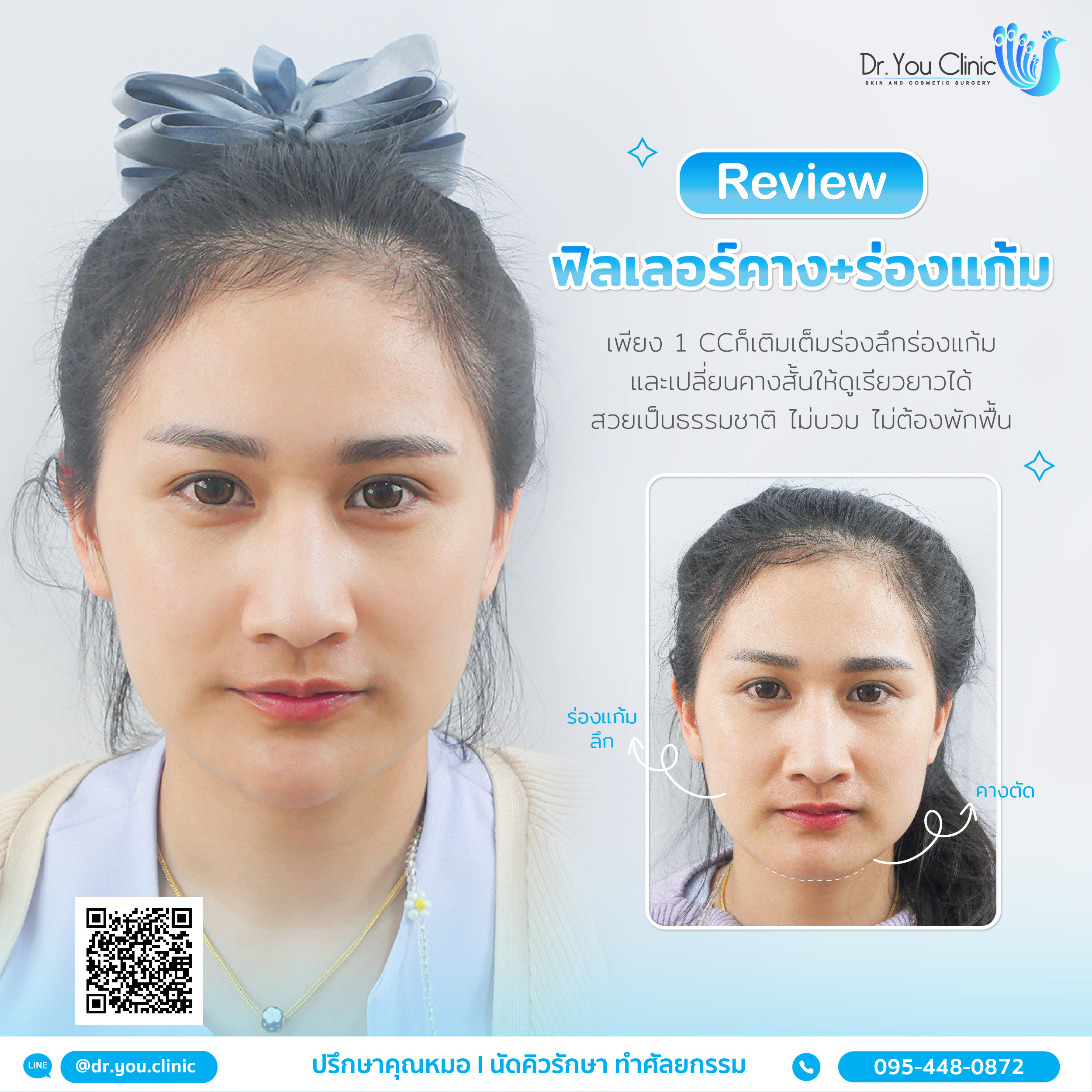 รีวิวฟิลเลอร์คาง