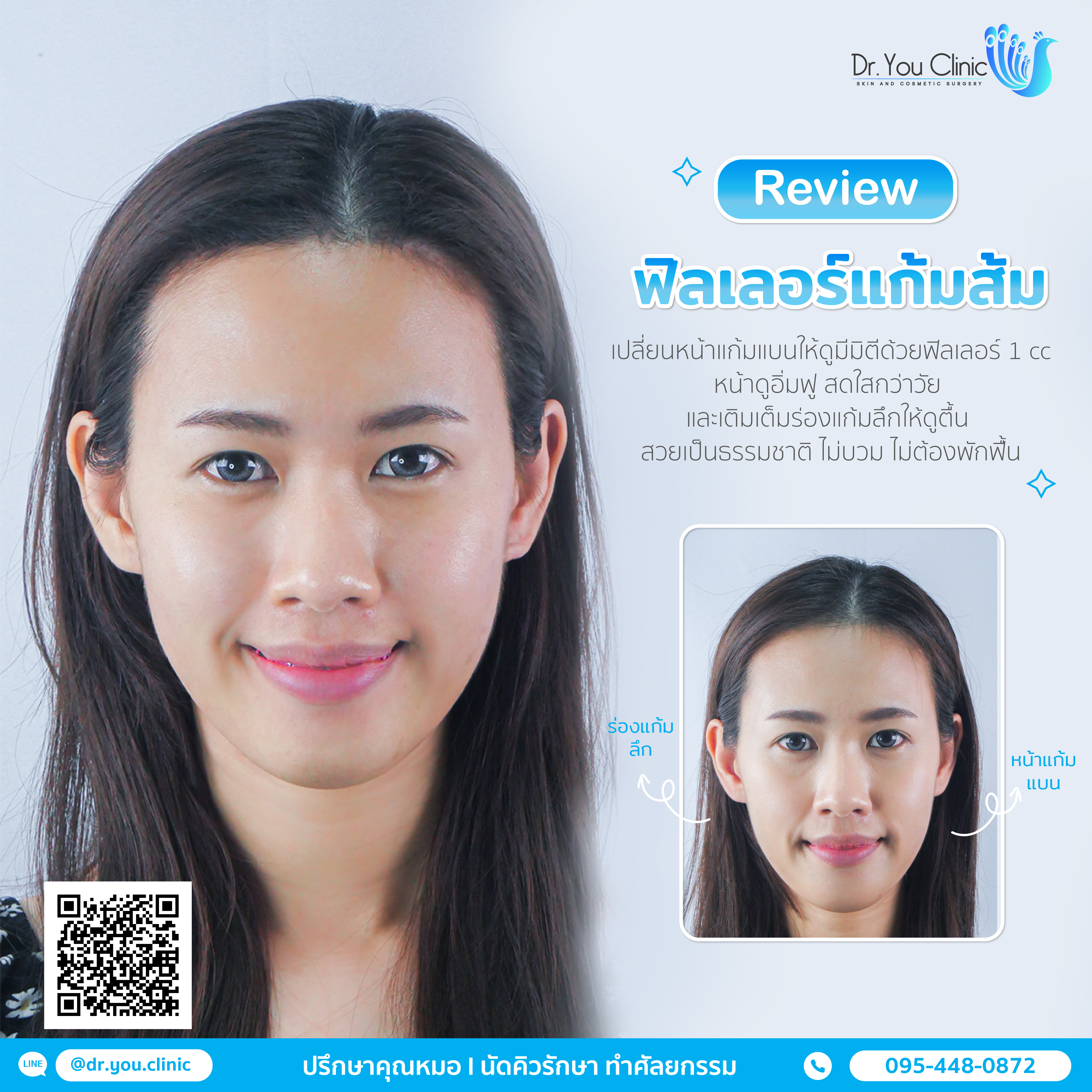 รีวิวฟิลเลอร์ร่องแก้ม+แก้มส้ม+แก้มตอบ