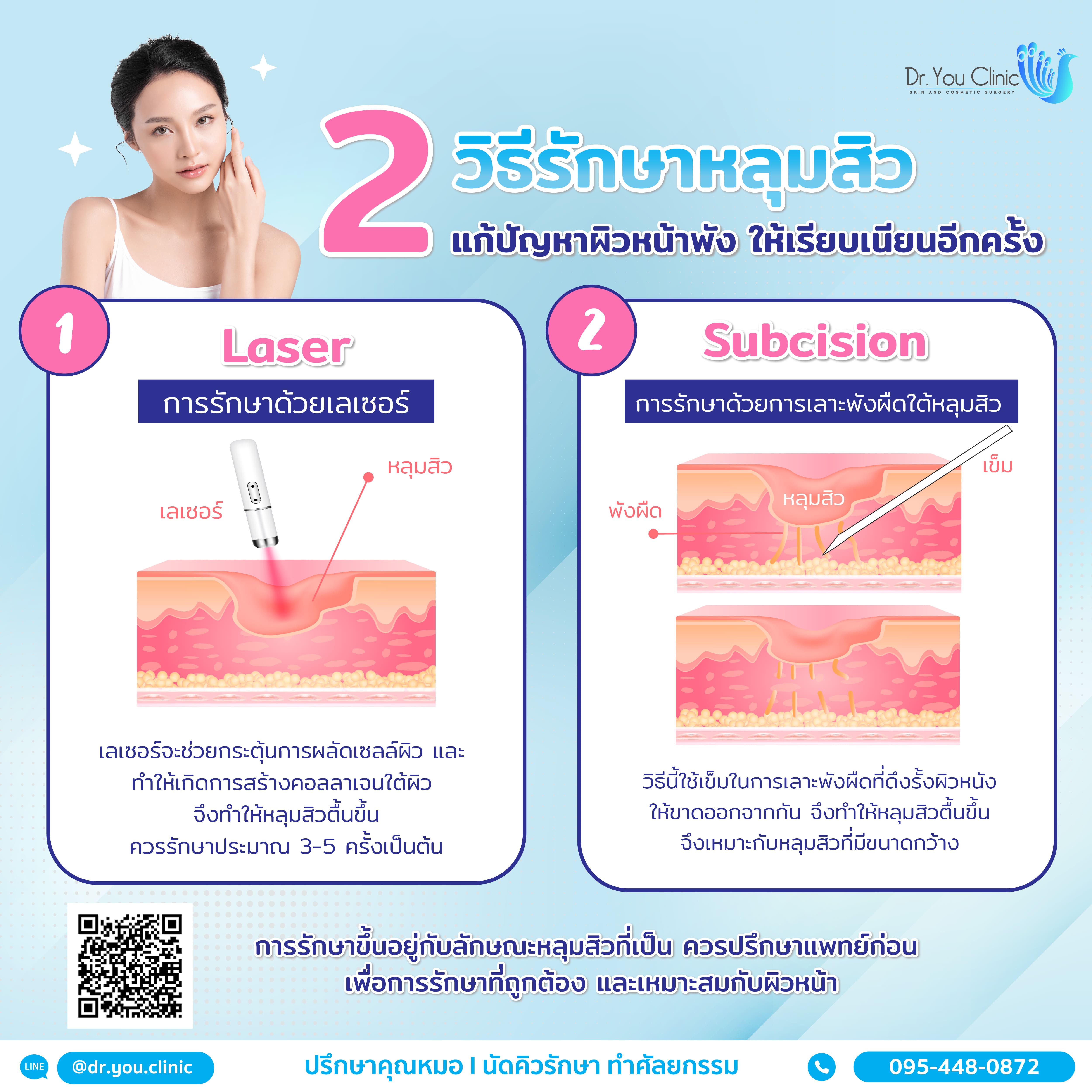 2 วิธีรักษาหลุมสิว แก้ปัญหาผิวหน้าพัง ให้เรียบเนียนอีกครั้ง!