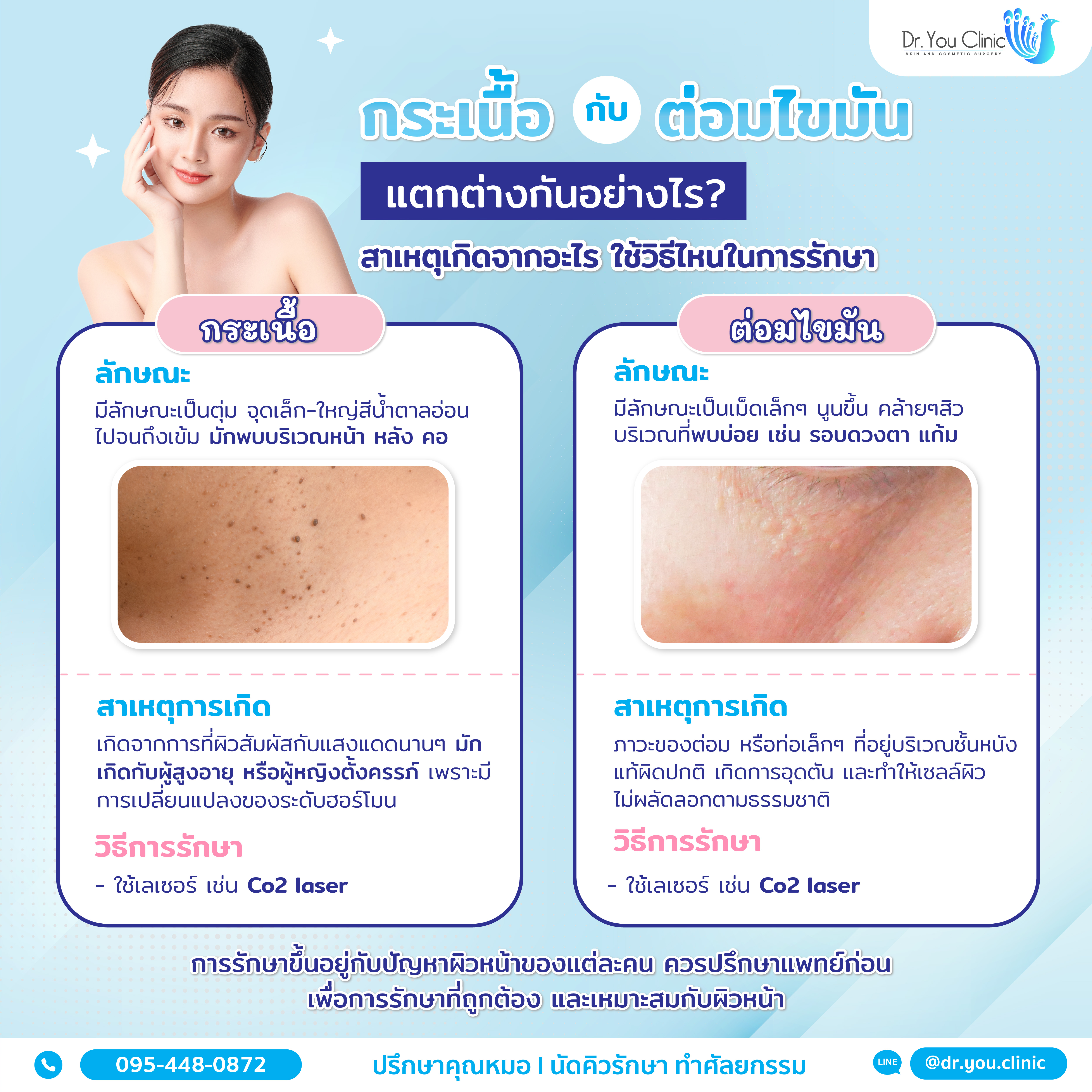 กระเนื้อ กับ ต่อมไขมัน แตกต่างกันอย่างไร?