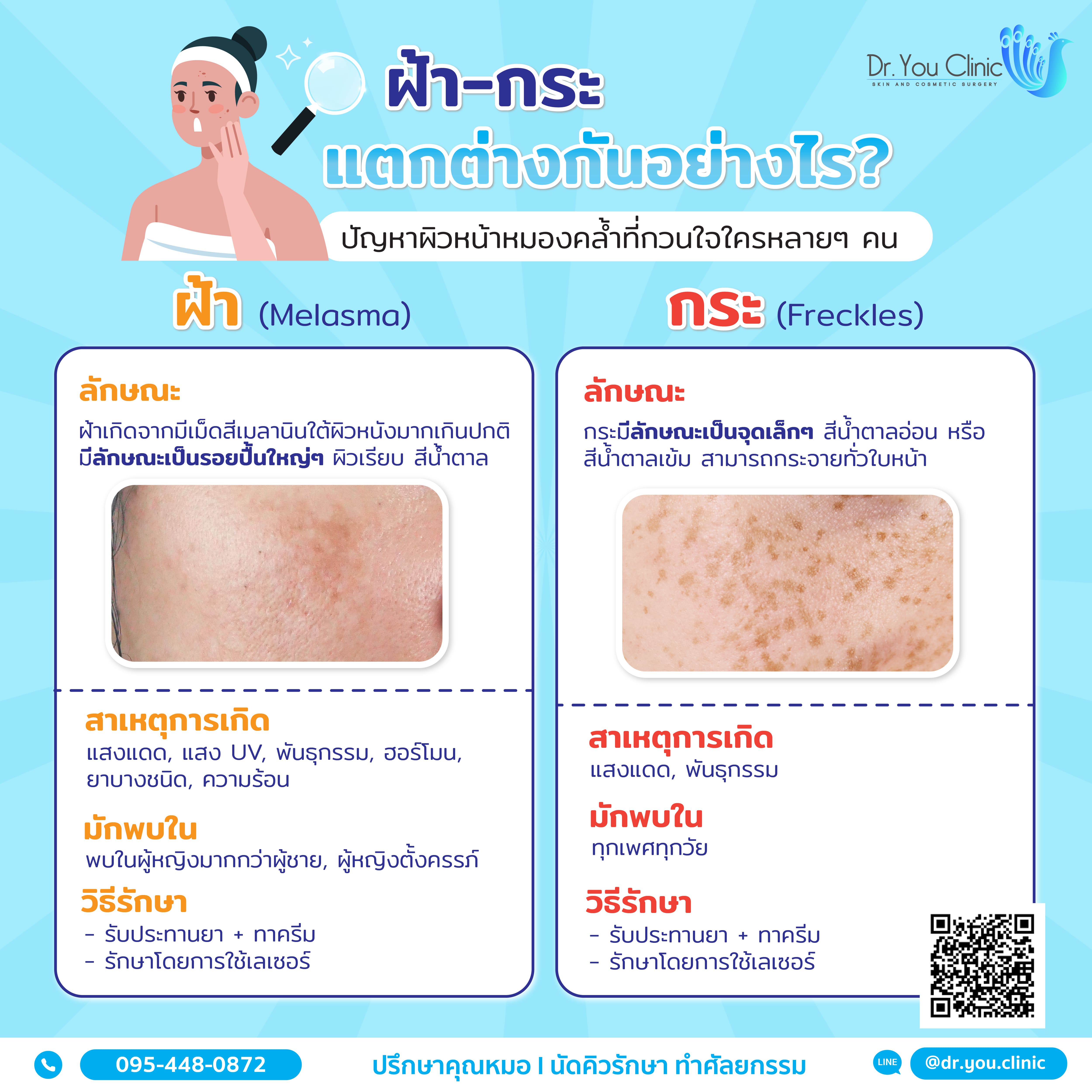 ฝ้า-กระ แตกต่างกันอย่างไร?